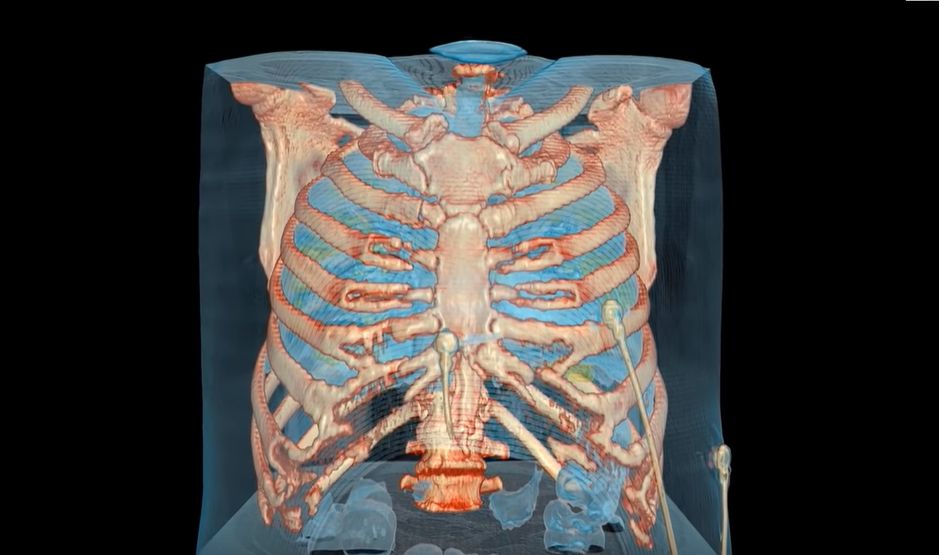 Imagini înspăimântătoare. Cum distruge noul coronavirus un plămân. VIDEO 3D