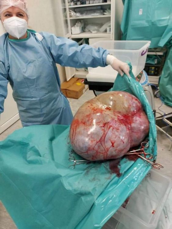 FOTO. Caz incredibil la Botoșani. Tumoare de 24 de kilograme, extirpată din abdomenul unei femei infectată cu COVID-19