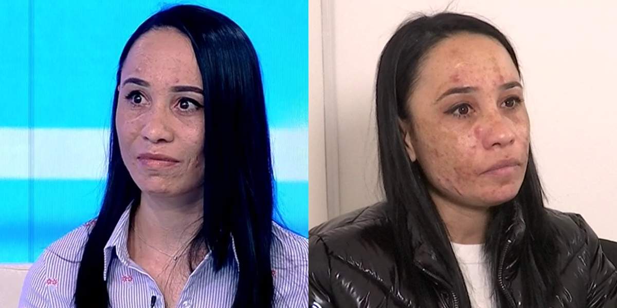 Fața i-a fost distrusă! O tânără a fost desfigurată de un cosmetician. „M-a nenorocit și aș vrea să plătească”