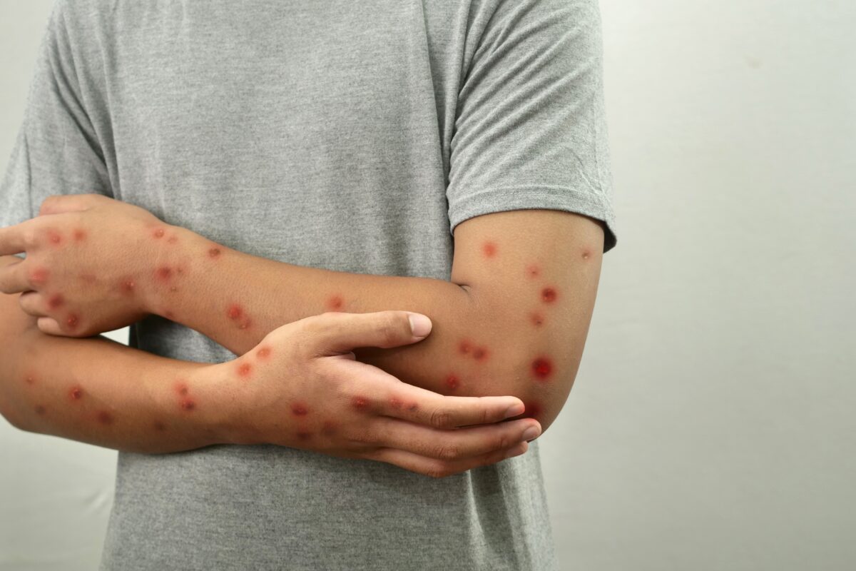 Ce este virusul mpox? A ajuns într-o țară din Europa în care locuiesc o mulțime de români